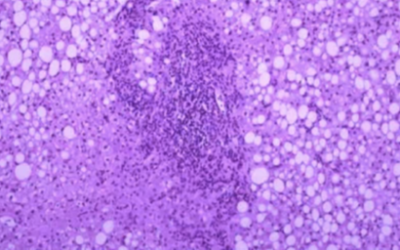 Infectious Disease and Aging