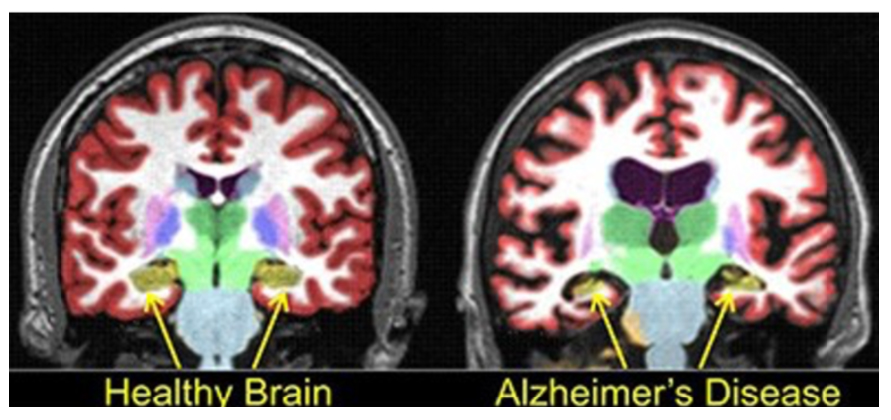 healthy brain vs alzheimers