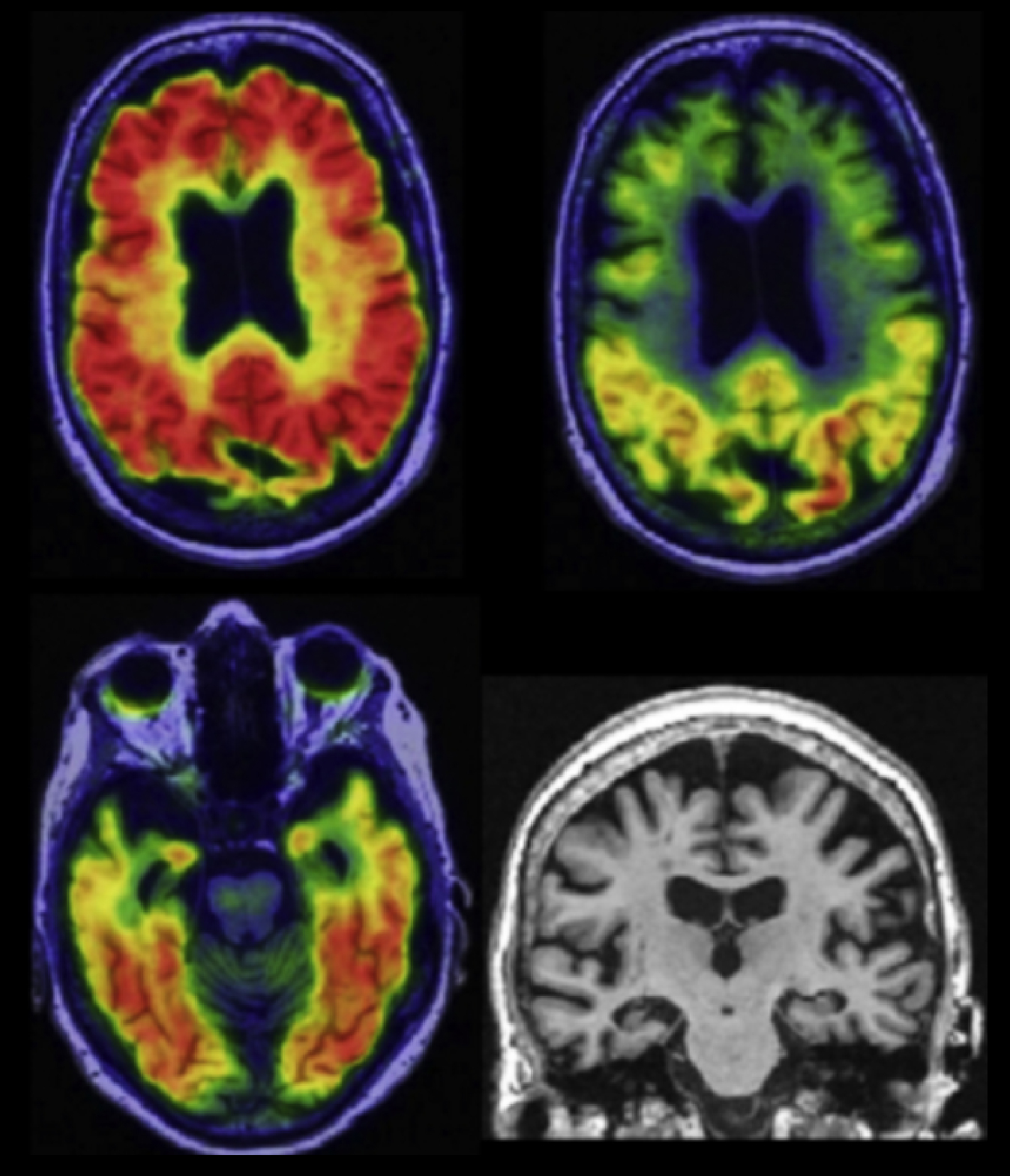 imaging biomarkers for Alzheimer’s disease